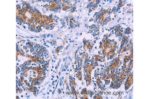 Immunohistochemistry of Human colon cancer using AGFG1 Polyclonal Antibody at dilution of 1:50