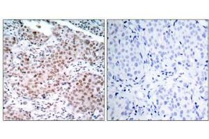 Immunohistochemical analysis of paraffin-embedded human breast carcinoma tissue using Estrogen Receptor-a(Phospho-Ser104) Antibody(left) or the same antibody preincubated with blocking peptide(right). (Estrogen Receptor alpha antibody  (pSer104))