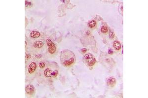 Immunohistochemical analysis of RAD23B staining in human lung cancer formalin fixed paraffin embedded tissue section. (RAD23B antibody  (N-Term))