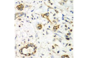 Immunohistochemistry of paraffin-embedded human liver cancer using NRBF2 antibody at dilution of 1:100 (x40 lens). (NRBF2 antibody)