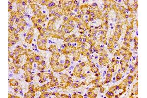 Immunohistochemistry of paraffin-embedded human liver cancer using ABIN7142326 at dilution of 1:100 (MPST antibody  (AA 102-208))