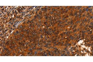 Immunohistochemistry of paraffin-embedded Human cervical cancer using PRKD1 Polyclonal Antibody at dilution of 1:40 (PKC mu antibody)