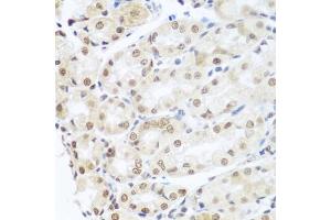 Immunohistochemistry of paraffin-embedded human gastric cancer using SNAI1 antibody. (SNAIL antibody)