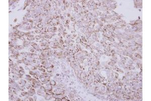 IHC-P Image Immunohistochemical analysis of paraffin-embedded human breast cancer, using Protein C, antibody at 1:250 dilution. (PROC antibody)
