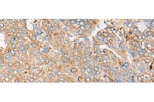 Immunohistochemistry of paraffin-embedded Human liver cancer tissue using CAPN9 Polyclonal Antibody at dilution of 1:45(x200) (Calpain 9 antibody)