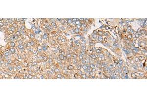 Immunohistochemistry of paraffin-embedded Human liver cancer tissue using CAPN9 Polyclonal Antibody at dilution of 1:45(x200)
