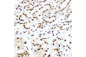 Immunohistochemical analysis of Pontin 52 staining in human gastric cancer formalin fixed paraffin embedded tissue section. (RUVBL1 antibody)