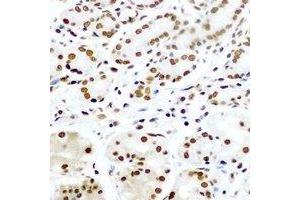 Immunohistochemical analysis of Pontin 52 staining in human gastric cancer formalin fixed paraffin embedded tissue section.