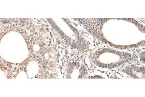 Immunohistochemistry of paraffin-embedded Human gastric cancer tissue using ZNF281 Polyclonal Antibody at dilution of 1:30(x200) (ZNF281 antibody)