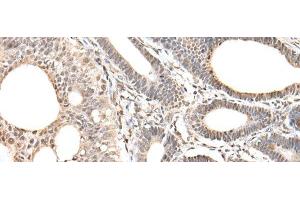 Immunohistochemistry of paraffin-embedded Human gastric cancer tissue using ZNF281 Polyclonal Antibody at dilution of 1:30(x200)