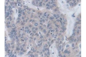 Detection of CRLF1 in Human Liver cancer Tissue using Polyclonal Antibody to Cytokine Receptor Like Factor 1 (CRLF1) (CRLF1 antibody  (AA 138-422))