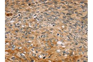 The image on the left is immunohistochemistry of paraffin-embedded Human esophagus cancer tissue using ABIN7192739(TBC1D21 Antibody) at dilution 1/30, on the right is treated with synthetic peptide. (TBC1D21 antibody)