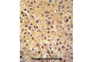 WBSCR27 antibody (N-term) immunohistochemistry analysis in formalin fixed and paraffin embedded human hepatocarcinoma followed by peroxidase conjugation of the secondary antibody and DAB staining. (WBSCR27 antibody  (N-Term))