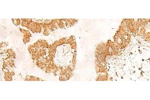 Immunohistochemistry of paraffin-embedded Human liver cancer tissue using POLR1D Polyclonal Antibody at dilution of 1:50(x200) (POLR1D antibody)