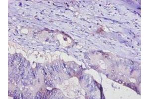 Immunohistochemistry of paraffin-embedded human colon cancer using ABIN7143414 at dilution of 1:100 (ADIPOQ antibody  (AA 19-244))