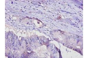 Immunohistochemistry of paraffin-embedded human colon cancer using ABIN7143414 at dilution of 1:100 (ADIPOQ antibody  (AA 19-244))