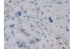 Detection of DEFa4 in Human Bile duct cancer Tissue using Polyclonal Antibody to Defensin Alpha 4, Corticostatin (DEFa4) (DEFA4 antibody  (AA 23-97))