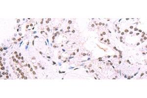 Immunohistochemistry of paraffin-embedded Human thyroid cancer tissue using IRF2BP1 Polyclonal Antibody at dilution of 1:40(x200) (IRF2BP1 antibody)