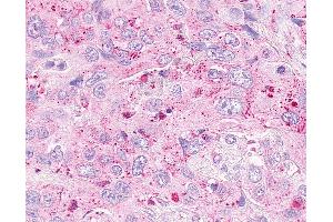 Anti-OXER1 antibody IHC of human Pancreas, Carcinoma. (OXER1 antibody  (C-Term))