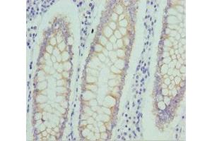 Immunohistochemistry of paraffin-embedded human colon cancer using ABIN7161746 at dilution of 1:100