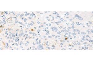 Immunohistochemistry of paraffin-embedded Human cervical cancer tissue using FABP4 Polyclonal Antibody at dilution of 1:60(x200) (FABP4 antibody)