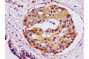 IHC image of ABIN7171142 diluted at 1:100 and staining in paraffin-embedded human breast cancer performed on a Leica BondTM system. (SNAP23 antibody  (AA 90-196))