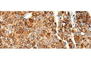 Immunohistochemistry of paraffin-embedded Human liver cancer tissue using CACNG5 Polyclonal Antibody at dilution of 1:50(x200) (CACNG5 antibody)