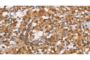 Immunohistochemistry of paraffin-embedded Human thyroid cancer tissue using CD13 Polyclonal Antibody at dilution 1:80 (CD13 antibody)