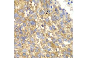 Immunohistochemistry of paraffin-embedded human esophageal cancer using EIF2AK4 antibody (ABIN5974303) at dilution of 1/100 (40x lens). (GCN2 antibody)