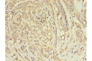 Immunohistochemistry of paraffin-embedded human breast cancer using ABIN7144576 at dilution of 1:100 (ARFIP2 antibody  (AA 20-295))