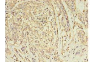 Immunohistochemistry of paraffin-embedded human breast cancer using ABIN7144576 at dilution of 1:100