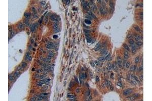 Detection of C2CD3 in Human Colorectal cancer Tissue using Polyclonal Antibody to C2 Calcium Dependent Domain Containing Protein 3 (C2CD3) (C2CD3 antibody  (AA 1432-1647))