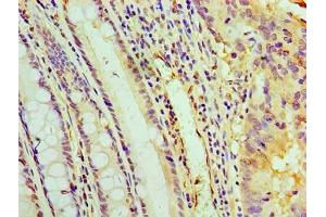 Immunohistochemistry of paraffin-embedded human colon cancer using ABIN7166888 at dilution of 1:100 (PYCR1 antibody  (AA 2-319))