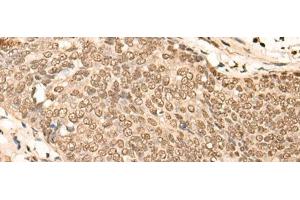 Immunohistochemistry of paraffin-embedded Human esophagus cancer tissue using EIF4A3 Polyclonal Antibody at dilution of 1:45(x200) (EIF4A3 antibody)