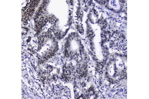IHC analysis of splicing factor 1 using anti-splicing factor 1 antibody . (Splicing Factor 1 antibody  (AA 160-266))