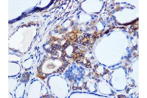 Immunohistochemistry of paraffin-embedded human thyroid cancer using Pan Cadherin Rabbit mAb (ABIN1679719, ABIN3019268, ABIN3019269 and ABIN7101741) at dilution of 1:100 (40x lens). (CDH1,CDH2,CDH3,CDH4 antibody)