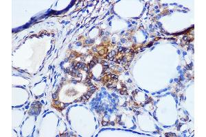 Immunohistochemistry of paraffin-embedded human thyroid cancer using Pan Cadherin Rabbit mAb (ABIN1679719, ABIN3019268, ABIN3019269 and ABIN7101741) at dilution of 1:100 (40x lens).