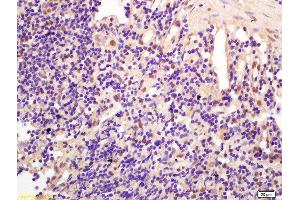 Formalin-fixed and paraffin embedded human gastric carcinoma labeled with Anti-CCDC147 Polyclonal Antibody, Unconjugated  at 1:200 followed by conjugation to the secondary antibody and DAB staining (CCDC147 antibody  (AA 161-260))
