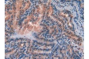 DAB staining on IHC-P; Samples: Human Thyroid cancer Tissue (FZD1 antibody  (AA 117-322))