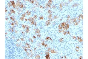 Formalin-fixed, paraffin-embedded human Hodgkin's Lymphoma stained with CD30 Monoclonal Antibody (SPM121). (TNFRSF8 antibody)