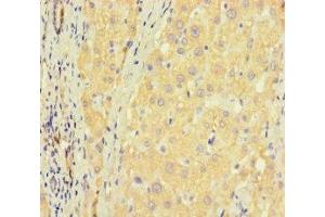 Immunohistochemistry of paraffin-embedded human liver cancer using ABIN7176405 at dilution of 1:100 (ZNF583 antibody  (AA 1-300))