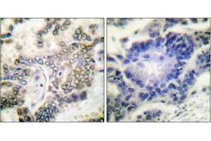 Immunohistochemistry analysis of paraffin-embedded human lung carcinoma tissue, using C/EBP-alpha (Ab-21) Antibody. (CEBPA antibody  (AA 6-55))