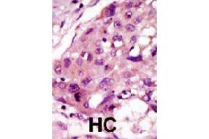 Formalin-fixed and paraffin-embedded human hepatocellular carcinoma tissue reacted with IRAK2 polyclonal antibody  , which was peroxidase-conjugated to the secondary antibody, followed by DAB staining. (IRAK2 antibody  (C-Term))