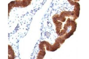 Formalin-fixed, paraffin-embedded human ovarian carcinoma stained with Cytokeratin 19 antibody (KRT19/799 + KRT19/800) (Cytokeratin 19 antibody)