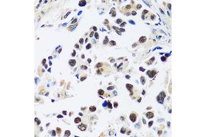Immunohistochemistry of paraffin-embedded human lung cancer using  antibody (ABIN7265374) at dilution of 1:100 (40x lens). (ASCL4 antibody  (AA 1-172))