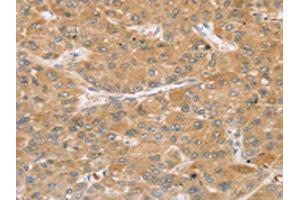 The image on the left is immunohistochemistry of paraffin-embedded Human liver cancer tissue using ABIN7192739(TBC1D21 Antibody) at dilution 1/30, on the right is treated with synthetic peptide. (TBC1D21 antibody)