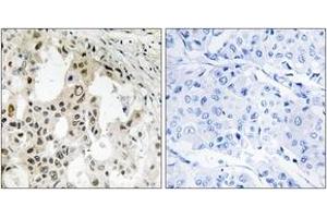 Immunohistochemistry analysis of paraffin-embedded human breast carcinoma tissue, using EIF3D Antibody.