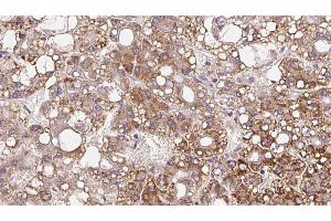 ABIN6272349 at 1/100 staining Human liver cancer tissue by IHC-P. (Mrgprf antibody  (C-Term))
