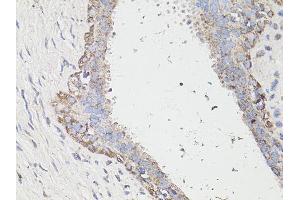 Immunohistochemistry of paraffin-embedded human breast cancer using MAP1LC3B antibody (ABIN6291774) at dilution of 1:100 (40x lens).