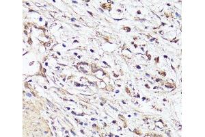 Immunohistochemistry of paraffin-embedded Human stomach cancer using VEGF Monoclonal Antibody at dilution of 1:150 (40x lens).